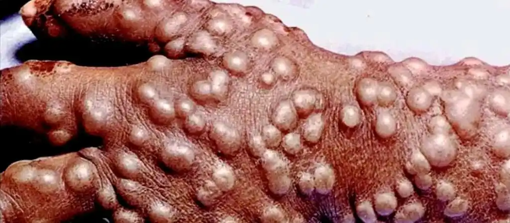 历史重大疫情回顾_查士丁尼瘟疫历史影响_疫情历史